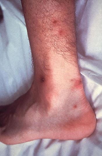 Gonorrhea
