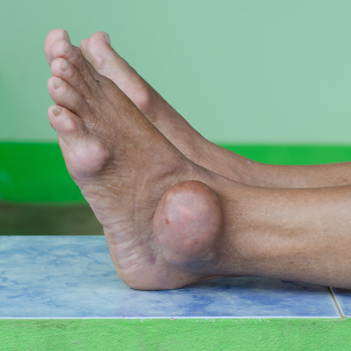 Gout