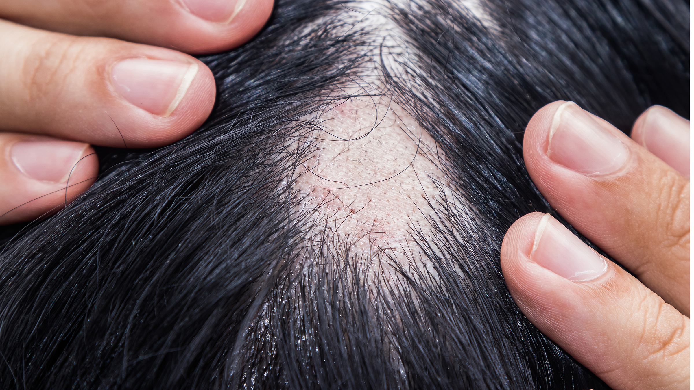 Hair loss