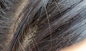 Head lice