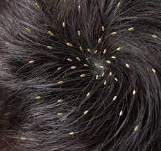 Head lice