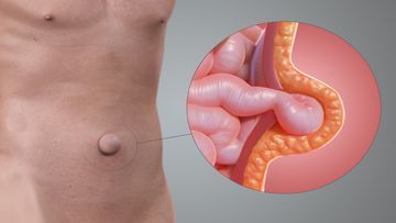 Hernia