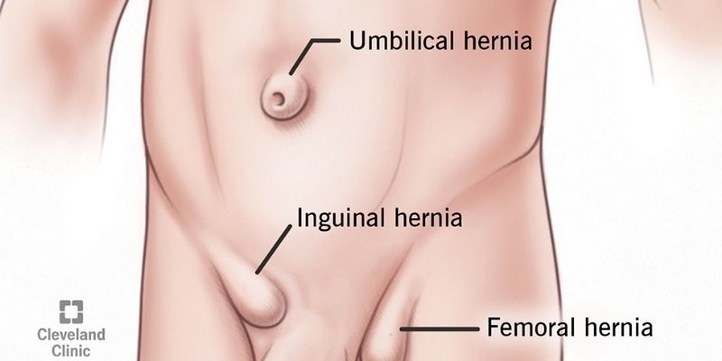 Hernia