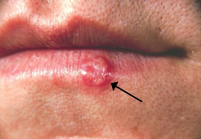 Herpes Simplex Virus Infections