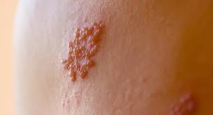 Herpes Simplex Virus Infections