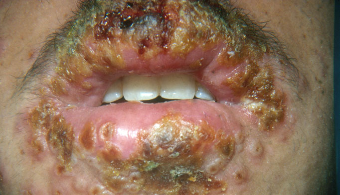 Herpes Simplex Virus Infections