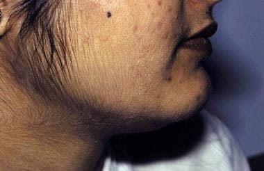Hirsutism