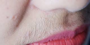 Hirsutism