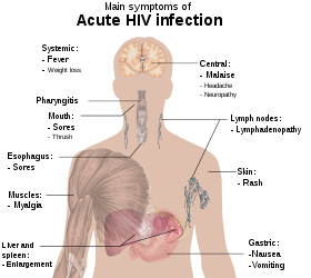 HIV infection