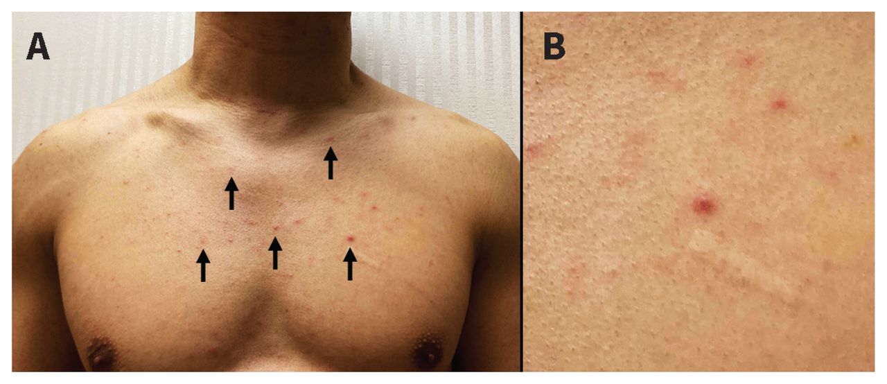 HIV infection