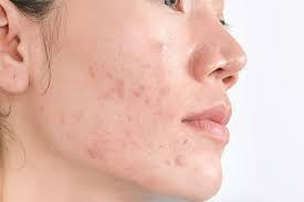 Hyperpigmentation