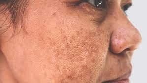 Hyperpigmentation