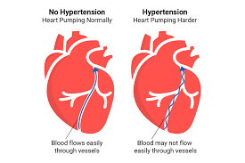 Hypertension (high blood pressure)