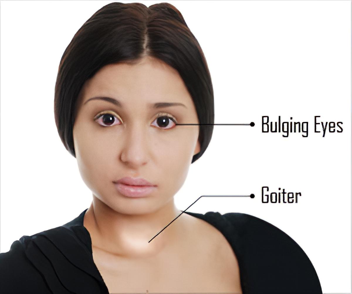 Hyperthyroidism