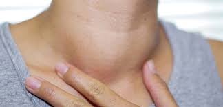 Hyperthyroidism