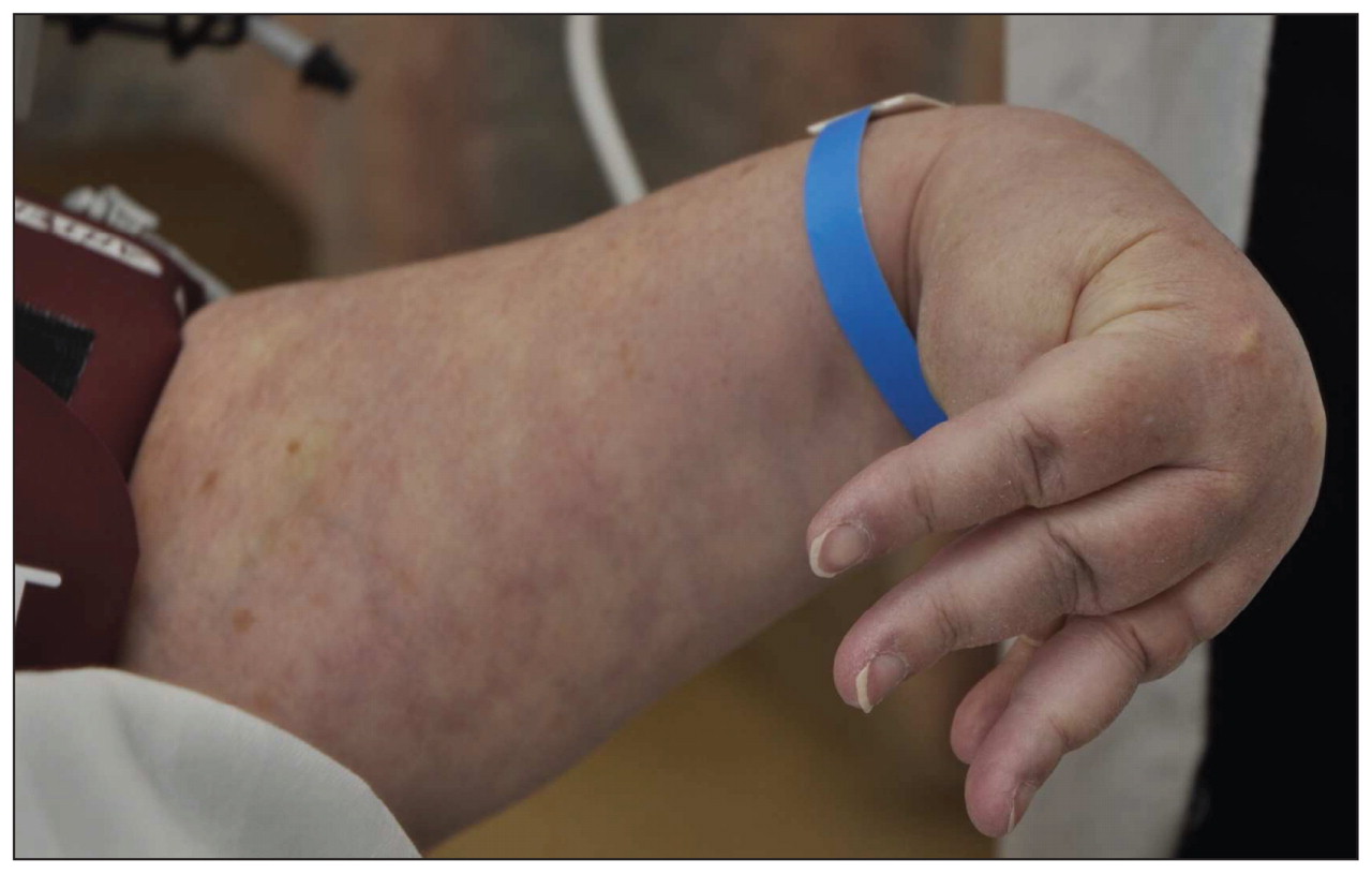 Hypocalcemia