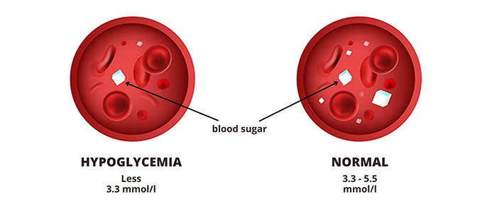 Hypoglycemia (low blood sugar)