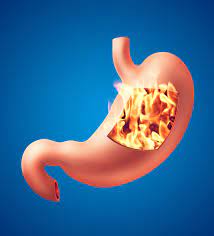 Indigestion