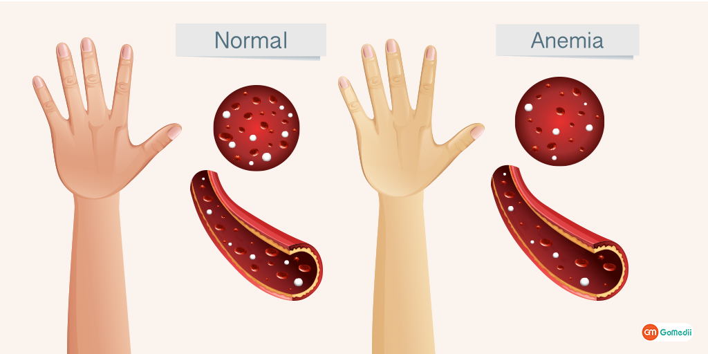 Iron deficiency anemia