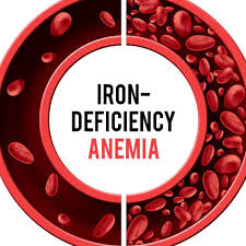 Iron deficiency anemia