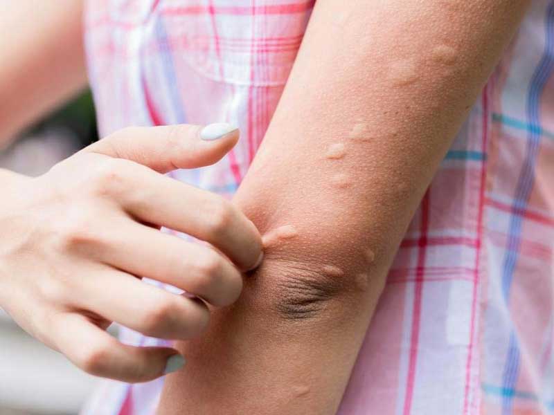 Japanese encephalitis