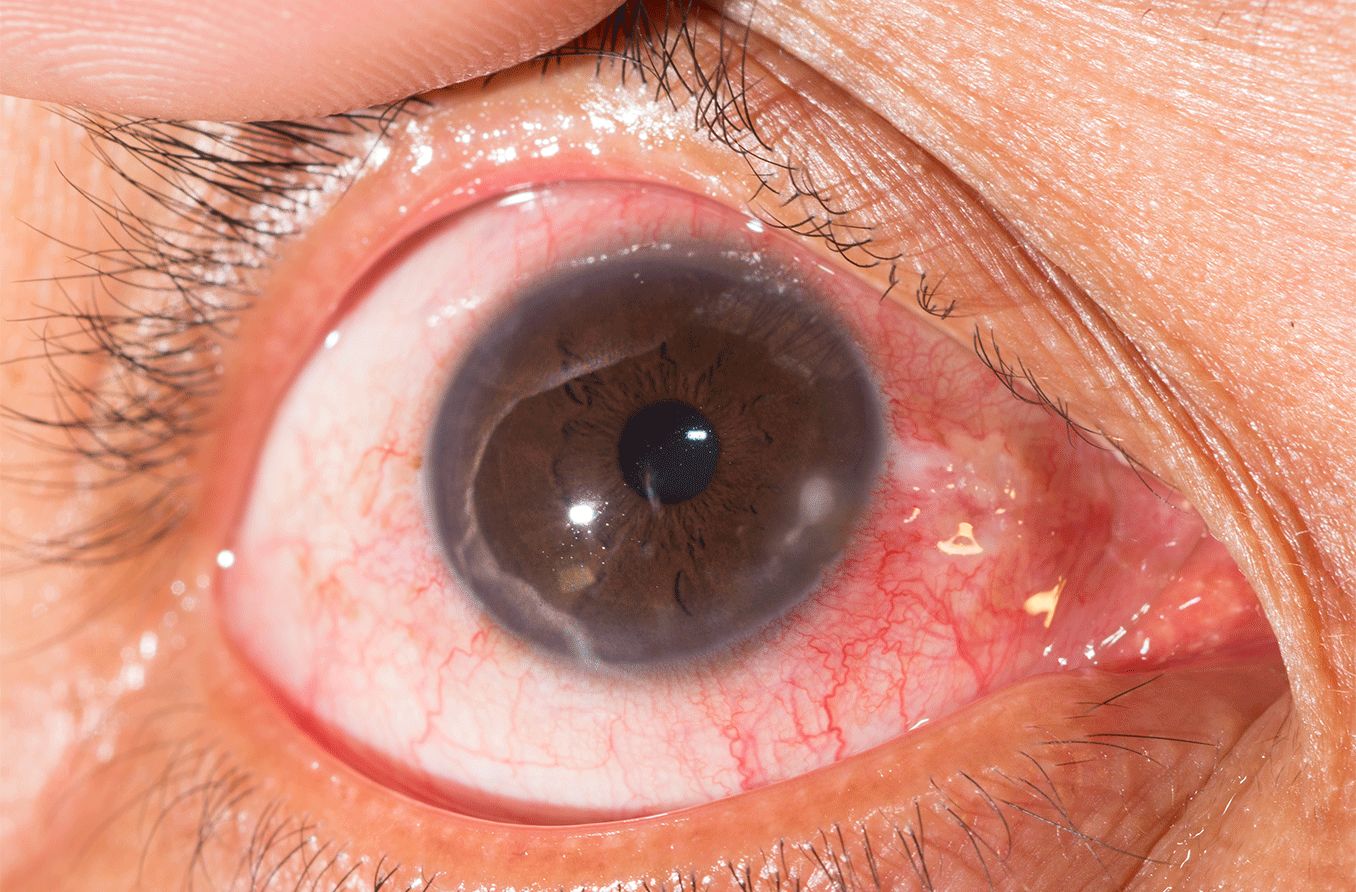 Keratitis