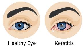 Keratitis
