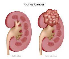 Kidney cancer
