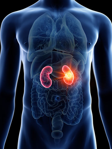 Kidney cancer