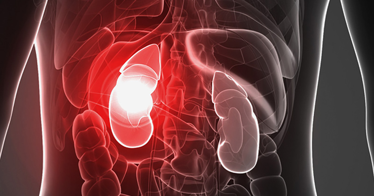 Kidney failure