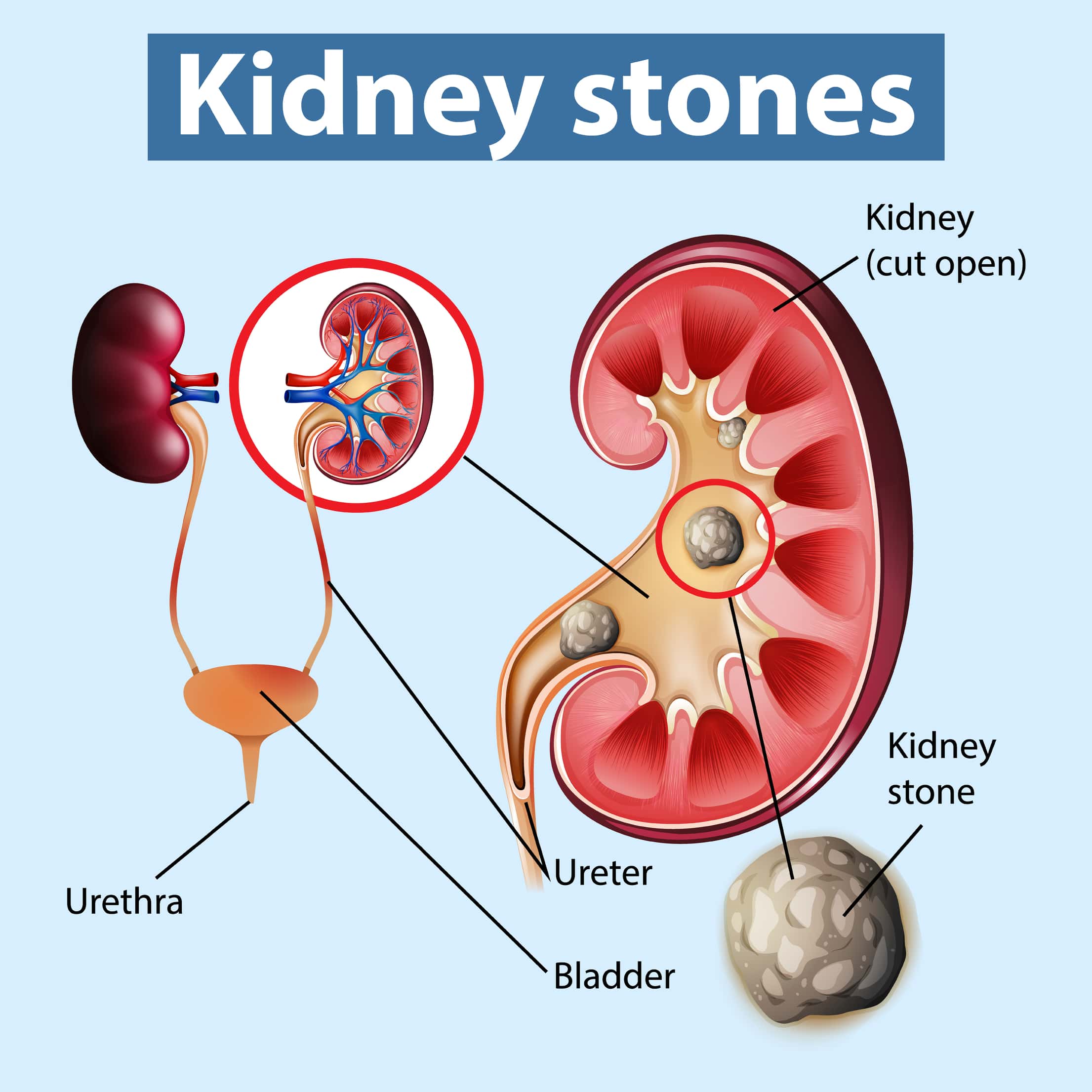 Kidney stone