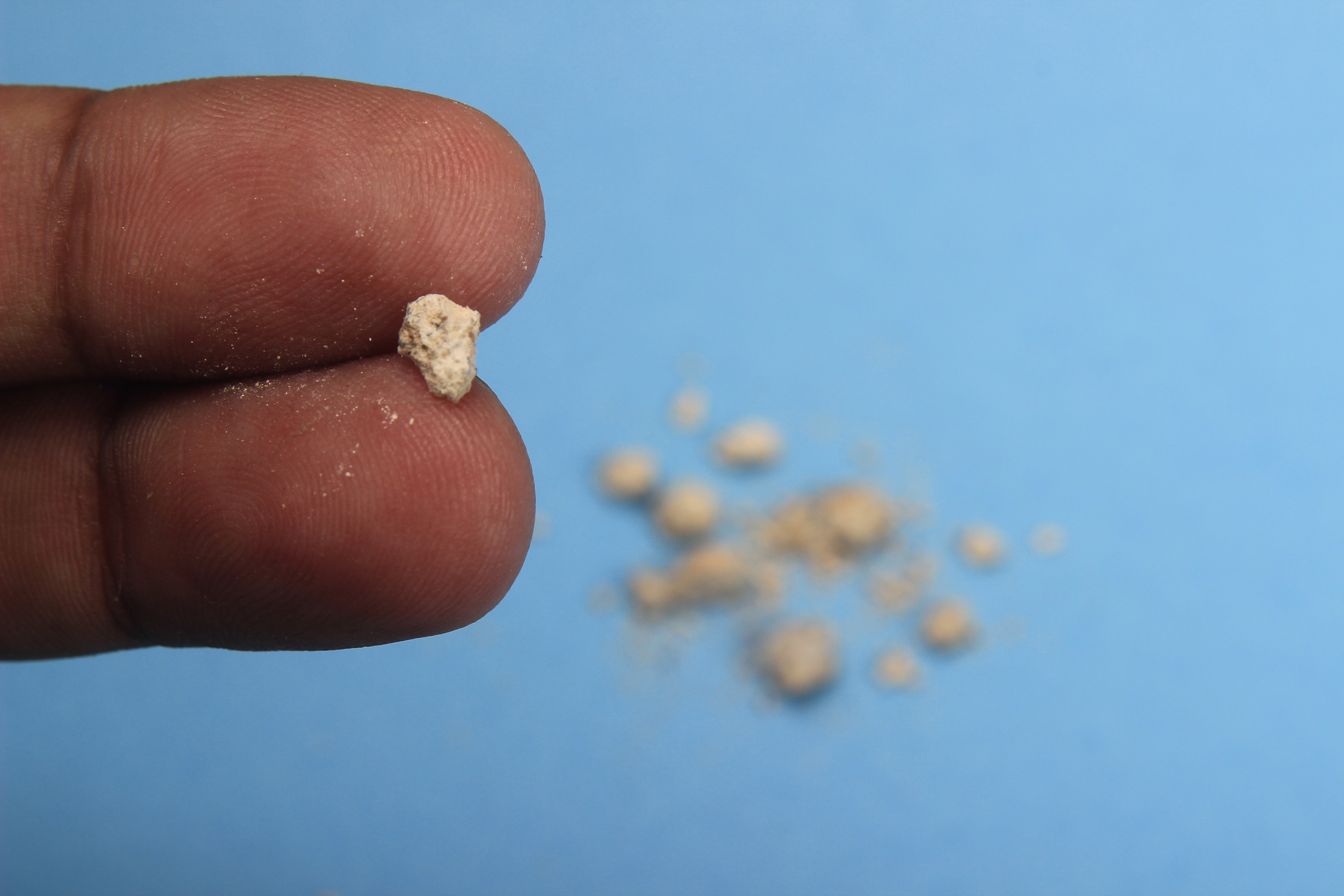 Kidney stone