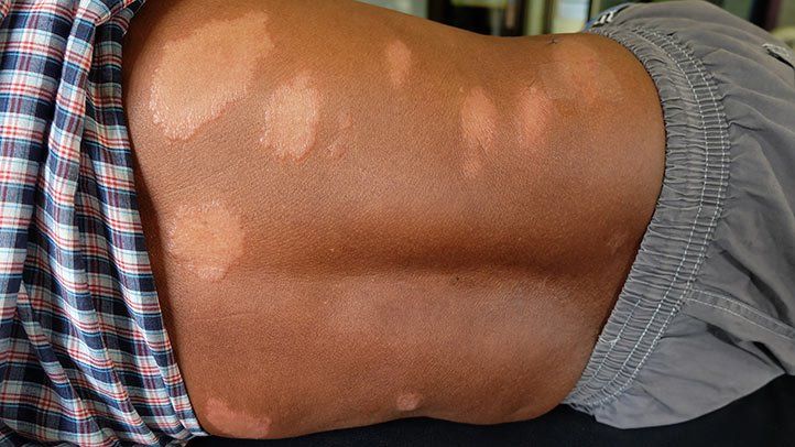 Leprosy