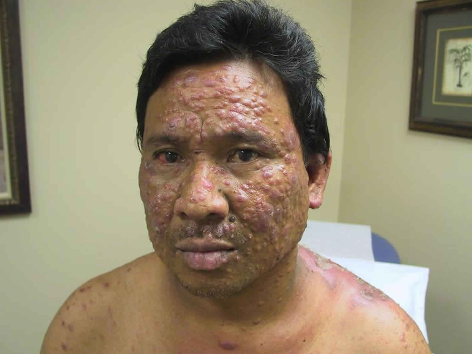 Leprosy