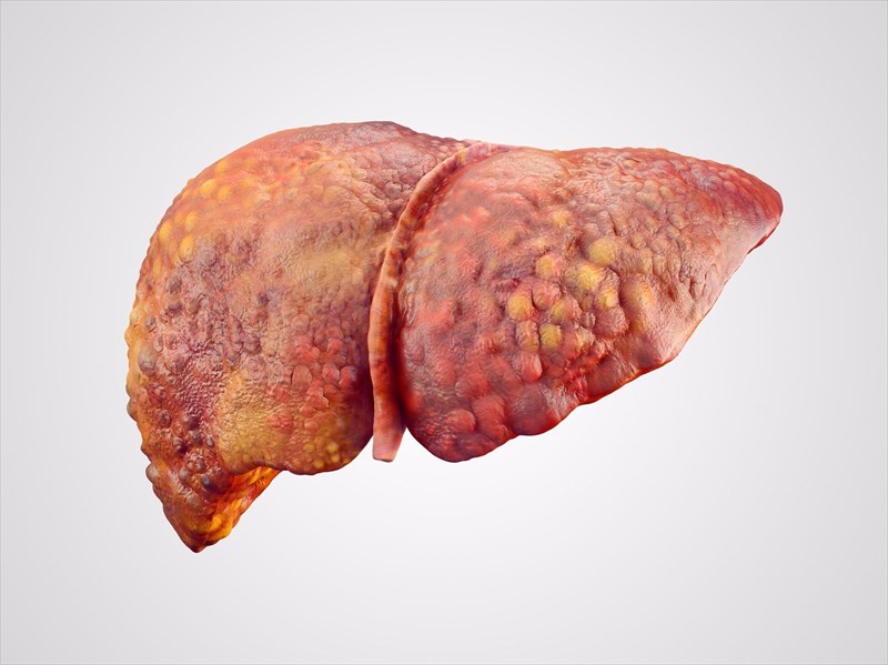 Liver cirrhosis