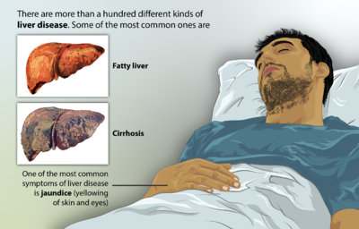 Liver cirrhosis