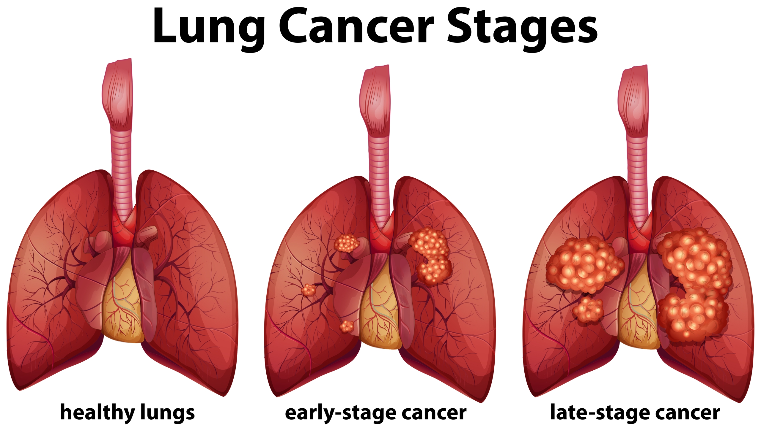 Lung cancer