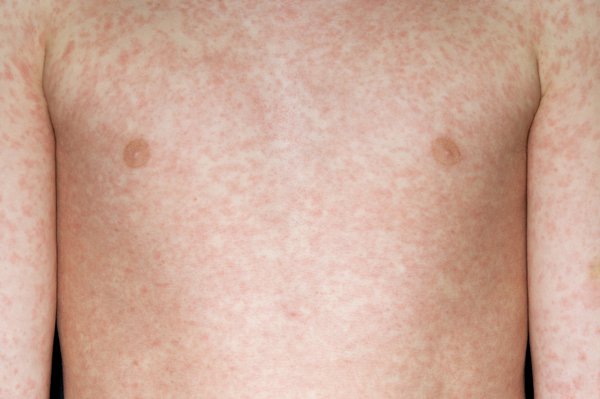 Measles