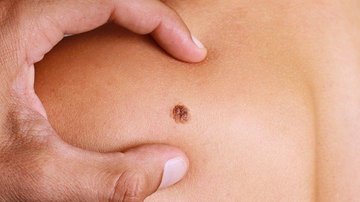 Melanoma