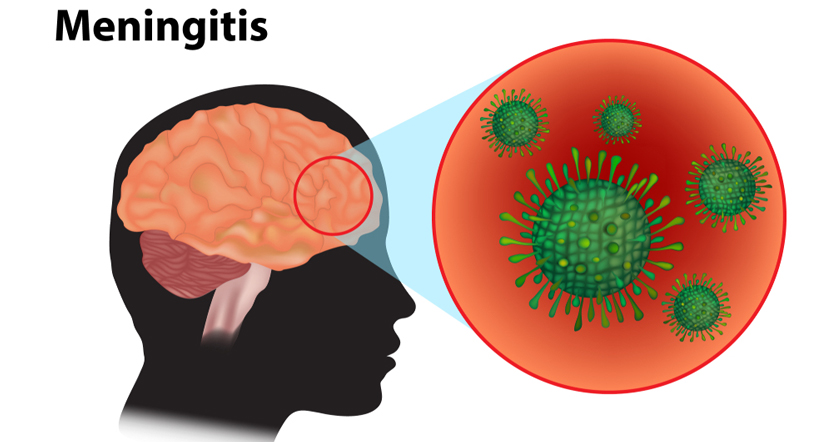 Meningitis