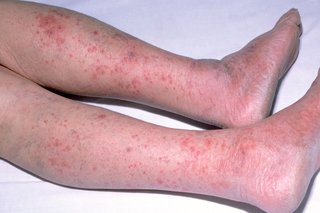 Meningitis