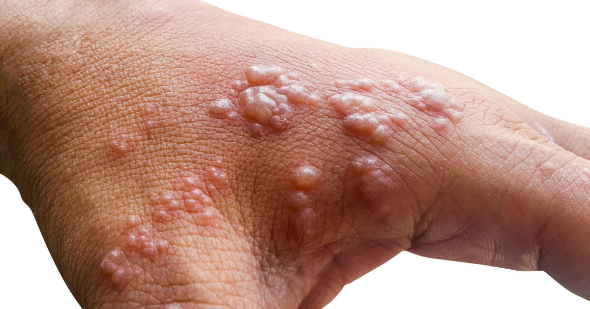 Monkeypox
