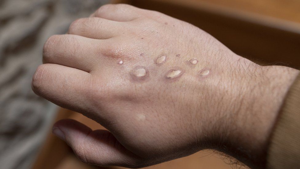 Monkeypox