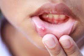 Mouth ulcers