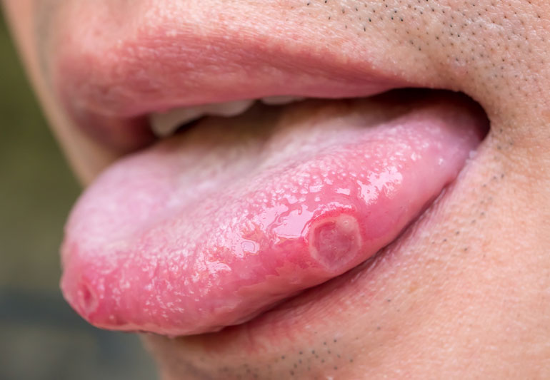 Mouth ulcers