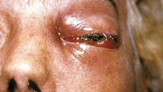 Mucormycosis