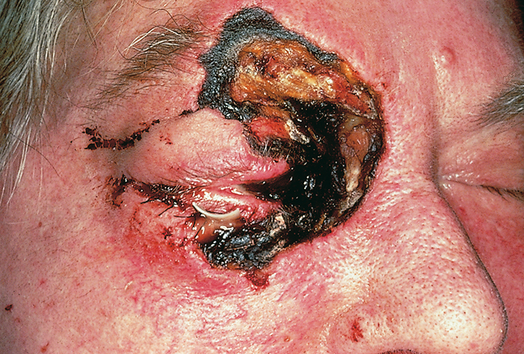 Mucormycosis
