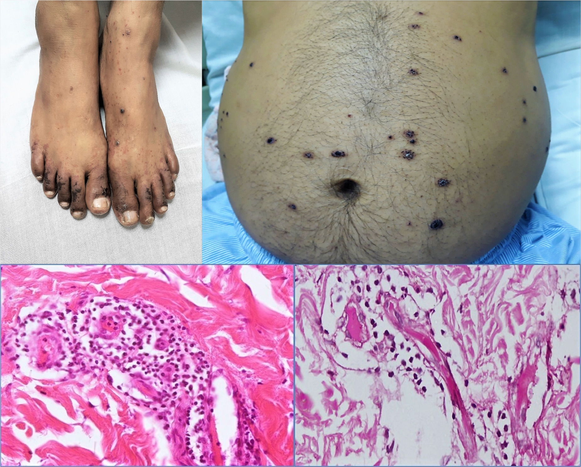 Multiple myeloma