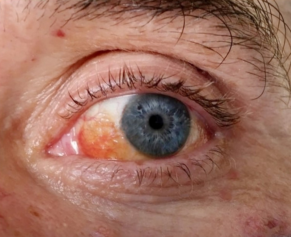 Multiple myeloma
