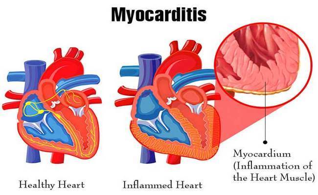 Myocarditis
